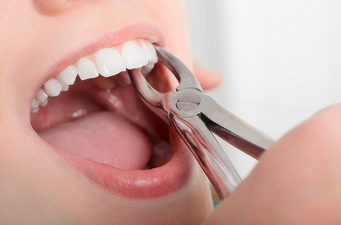مراقبت های مهم پس از کشیدن دندان در کلینیک های دندان پزشکی